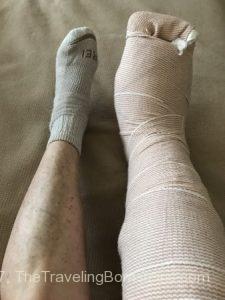 1 day post op from foot surgery