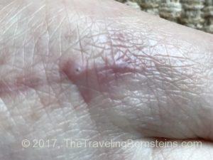 Dissolvable Stitch Trying to Come Through Incision Line